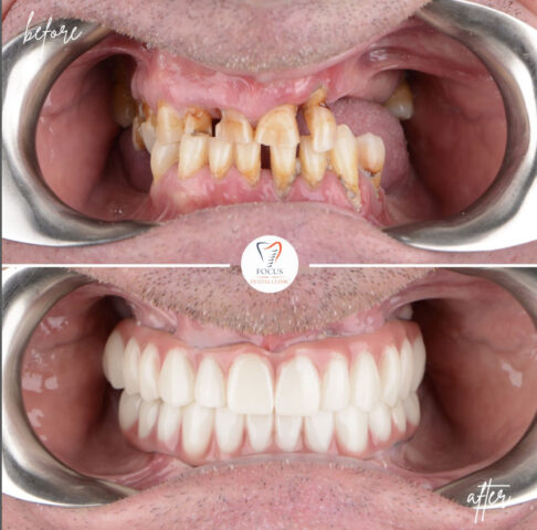 Focus Dental Clinic Bodrum All on 6 Before After