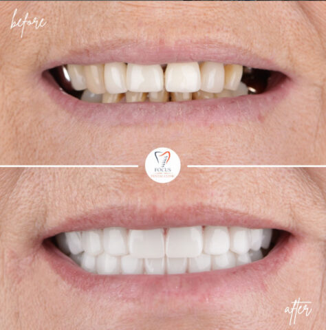 Focus Dental Clinic Bodrum All on 6 Before After