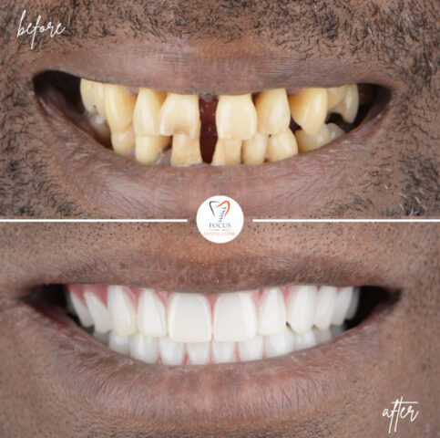 Focus Dental Clinic Bodrum All on 6 Before After