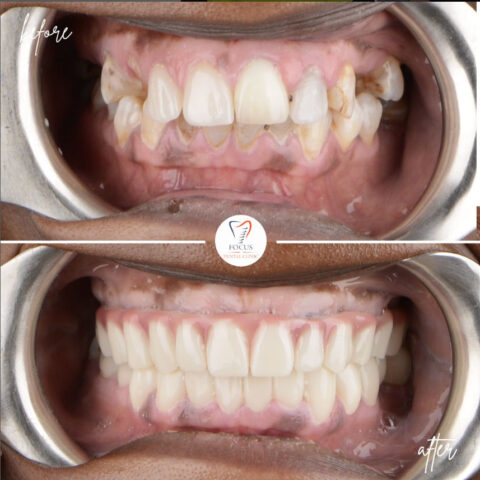 Focus Dental Clinic Bodrum All on 6 Before After