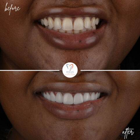 Focus Dental Clinic Turkey E-max & Zirconia Laminate Veneers Before After