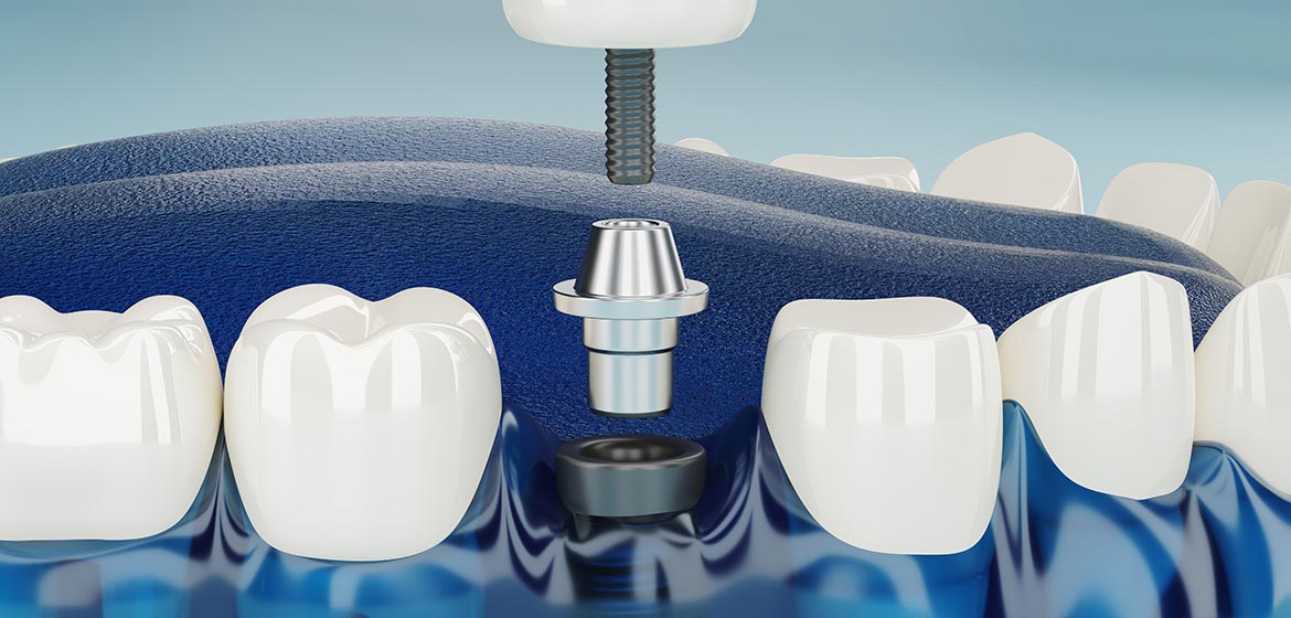 Implant Treatment in Diabetes