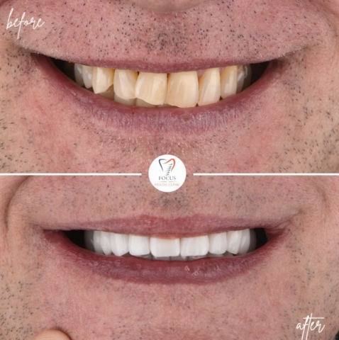 Focus Dental Clinic Bodrum Zirconia Crowns Before After