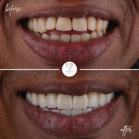 Focus Dental Clinic Bodrum Zirconia Crowns Before After