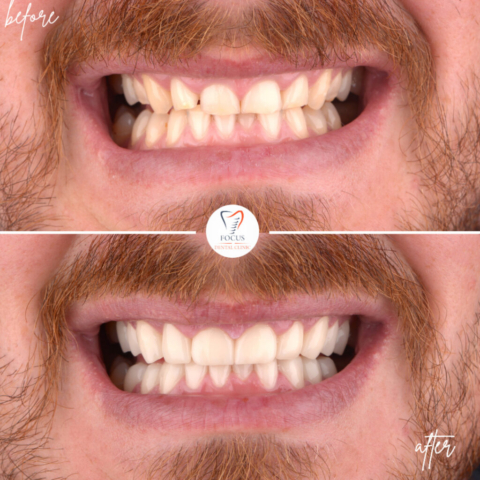 Focus Dental Clinic Bodrum Zirconia Crowns Before After