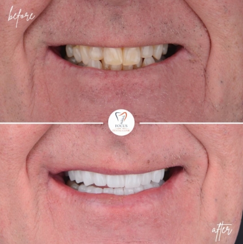 Focus Dental Clinic Bodrum Zirconia Crowns Before After