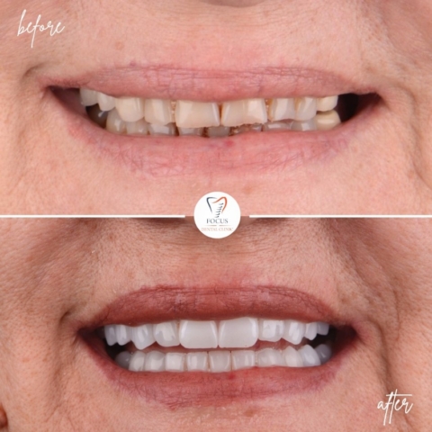Focus Dental Clinic Bodrum Zirconia Crowns Before After