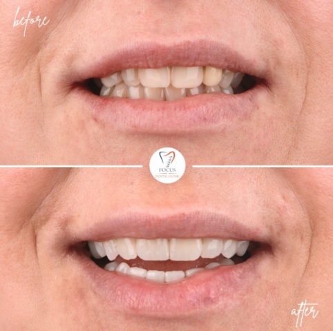 Focus Dental Clinic Bodrum Zirconia Crowns Before After