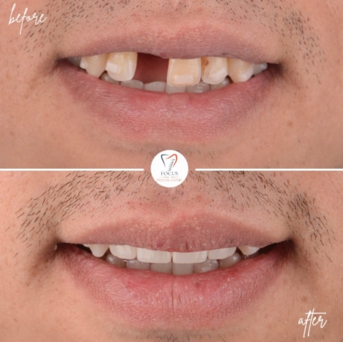 Focus Dental Clinic Bodrum Zirconia Crowns Before After
