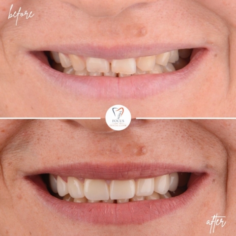 Focus Dental Clinic Bodrum Zirconia Crowns Before After
