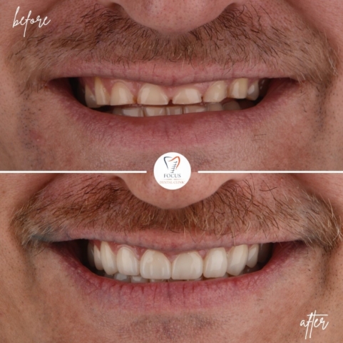 Focus Dental Clinic Bodrum Zirconia Crowns Before After