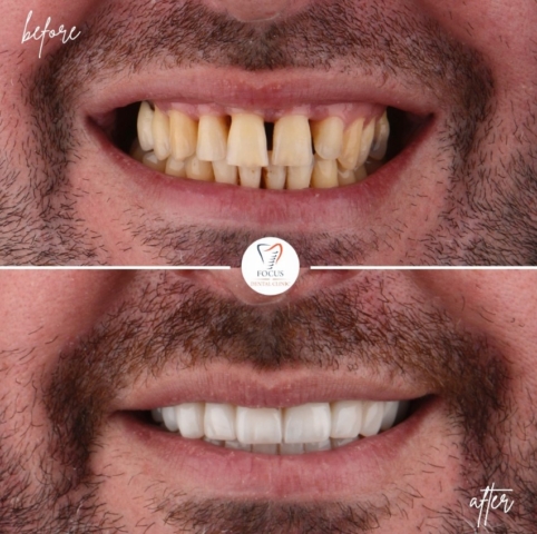 Focus Dental Clinic Bodrum Zirconia Crowns Before After