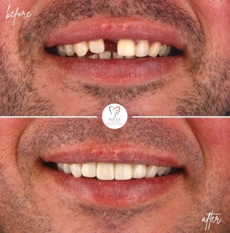 Focus Dental Clinic Bodrum Zirconia Crowns Before After