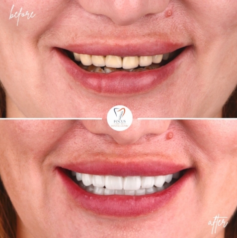 Focus Dental Clinic Bodrum Zirconia Crowns Before After