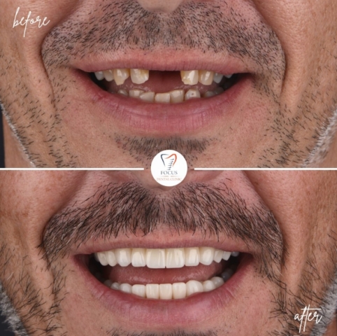 Focus Dental Clinic Bodrum Zirconia Crowns Before After