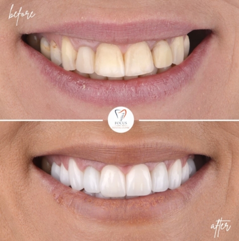 Focus Dental Clinic Bodrum Zirconia Crowns Before After