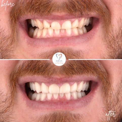 Focus Dental Clinic Bodrum Zirconia Crowns Before After