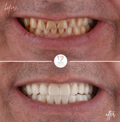 Focus Dental Clinic Bodrum Zirconia Crowns Before After