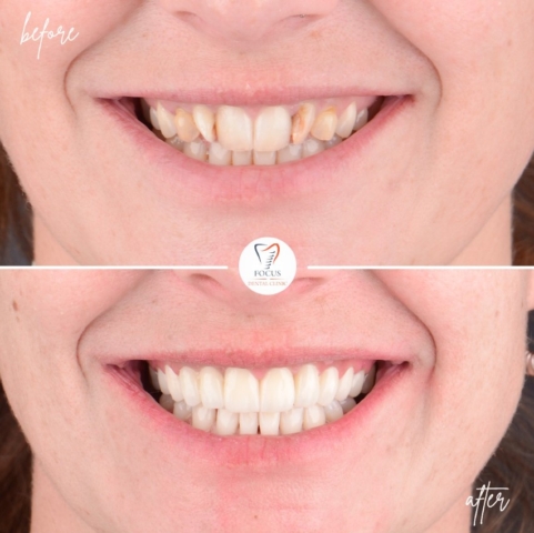 Focus Dental Clinic Bodrum Zirconia Crowns Before After