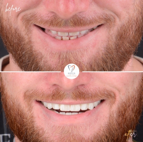 Focus Dental Clinic Bodrum Zirconia Crowns Before After