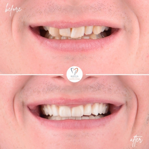 Focus Dental Clinic Bodrum Zirconia Crowns Before After