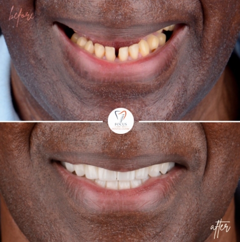 Focus Dental Clinic Bodrum Zirconia Crowns Before After