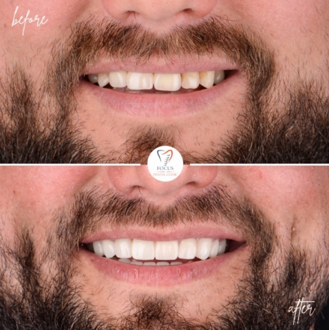 Focus Dental Clinic Bodrum Zirconia Crowns Before After