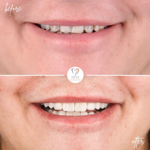Focus Dental Clinic Bodrum Zirconia Crowns Before After