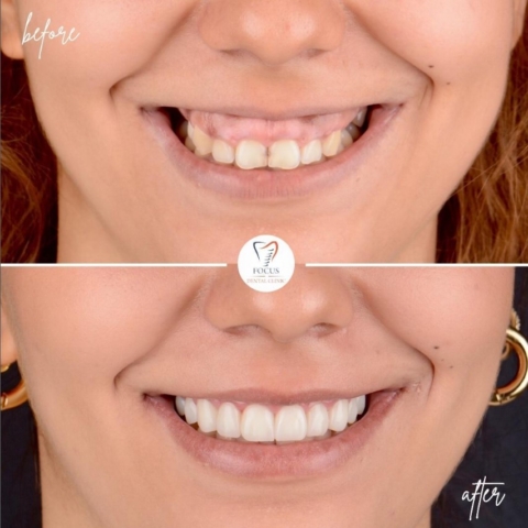 Focus Dental Clinic Bodrum Zirconia Crowns Before After