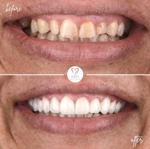 Focus Dental Clinic Bodrum Zirconia Crowns Before After