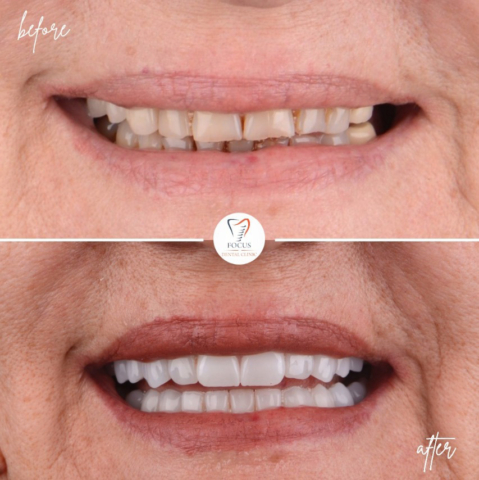 Focus Dental Clinic Bodrum Zirconia Crowns Before After