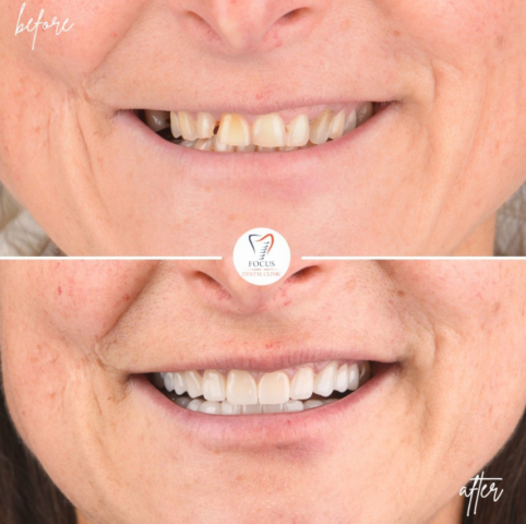 Focus Dental Clinic Bodrum Zirconia Crowns Before After