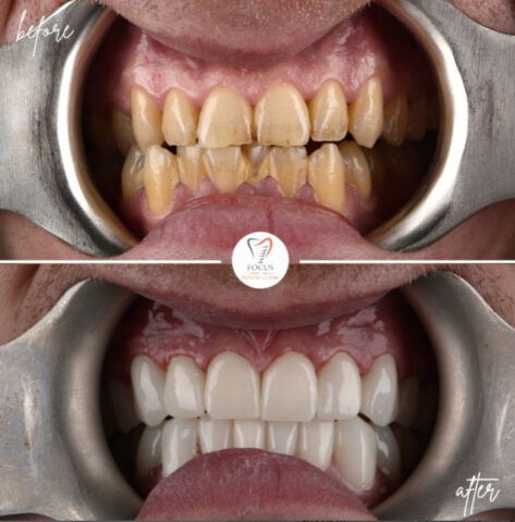 Focus Dental Clinic Bodrum Zirconia Crowns Before After