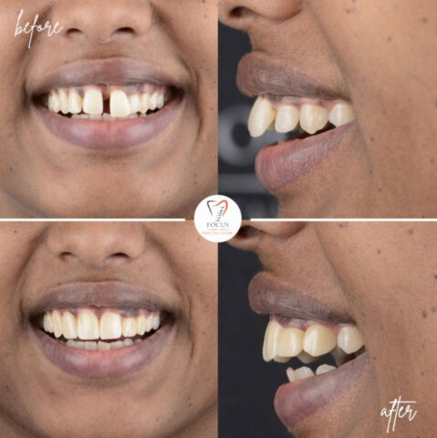Focus Dental Clinic Bodrum Zirconia Crowns Before After