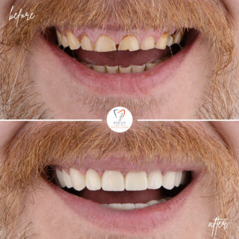 Focus Dental Clinic Bodrum Zirconia Crowns Before After