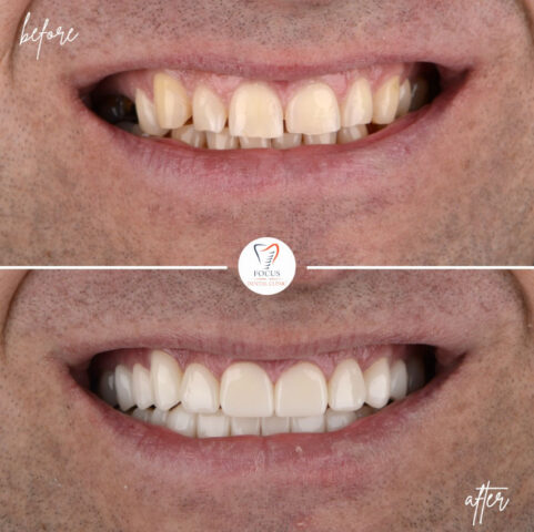 Focus Dental Clinic Bodrum Zirconia Crowns Before After