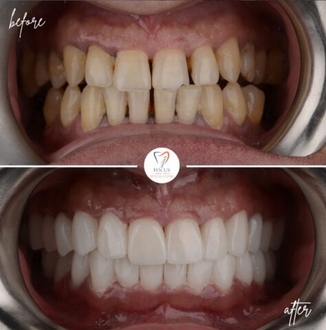 Focus Dental Clinic Bodrum Zirconia Crowns Before After