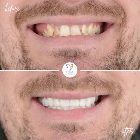 Focus Dental Clinic Bodrum Zirconia Crowns Before After