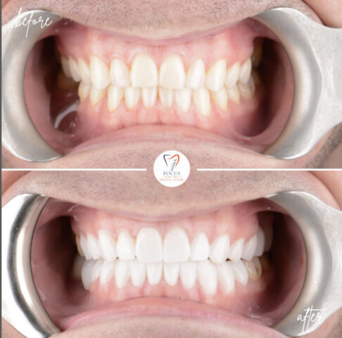 Focus Dental Clinic Bodrum Zirconia Crowns Before After