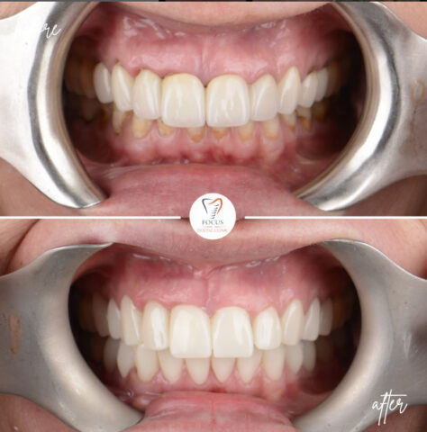 Focus Dental Clinic Bodrum Zirconia Crowns Before After