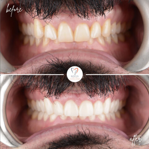 Focus Dental Clinic Bodrum Zirconia Crowns Before After