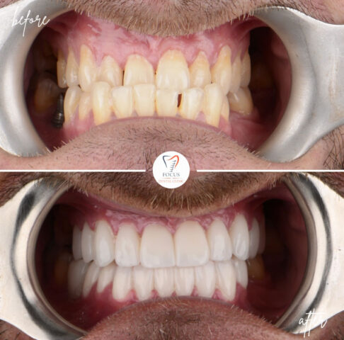 Focus Dental Clinic Bodrum Zirconia Crowns Before After