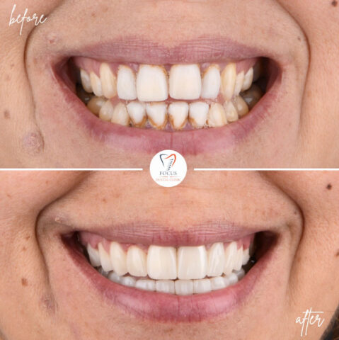 Focus Dental Clinic Bodrum Zirconia Crowns Before After