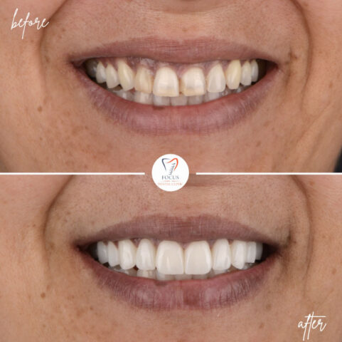 Focus Dental Clinic Bodrum Zirconia Crowns Before After
