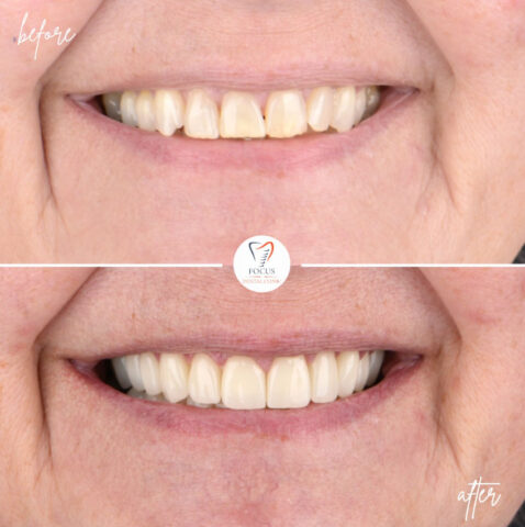 Focus Dental Clinic Bodrum Zirconia Crowns Before After