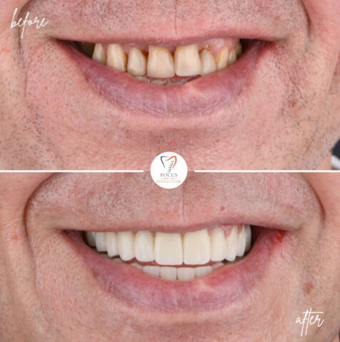Focus Dental Clinic Bodrum Zirconia Crowns Before After