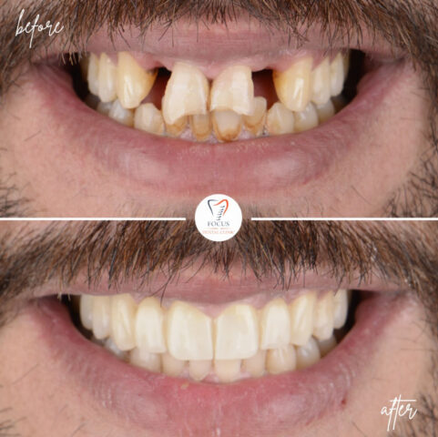 Focus Dental Clinic Bodrum Zirconia Crowns Before After