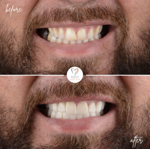 Focus Dental Clinic Bodrum Zirconia Crowns Before After