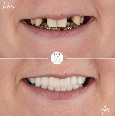 Focus Dental Clinic Bodrum Zirconia Crowns Before After